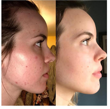 Load image into Gallery viewer, The Ordinary Azelaic Acid Suspension 10% Acne Face Cream